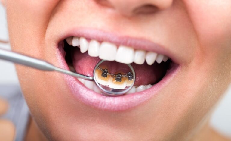 Close-up of dental braces adjustment.